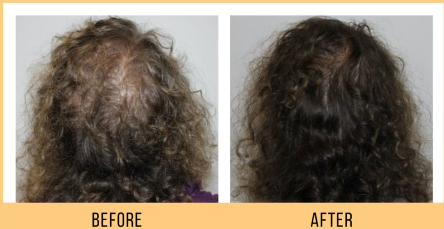 keravive hair loss treatment