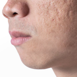 acne scars dearborn